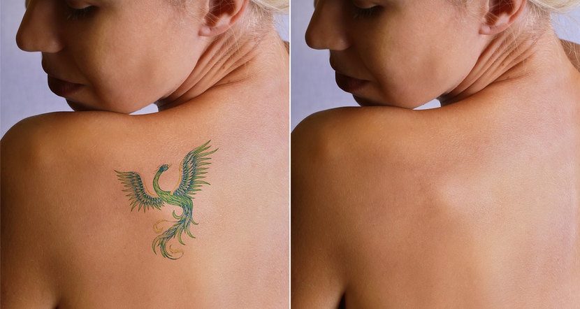 Take It Off • Tattoo Removal & Alt Spa