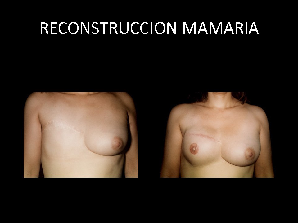 Reconstruccion_mamaria_02