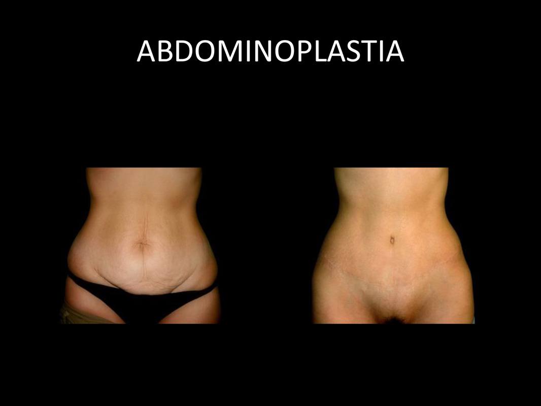 abdominoplastia_06