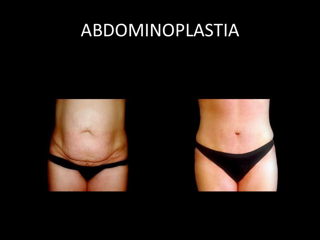 abdominoplastia_07