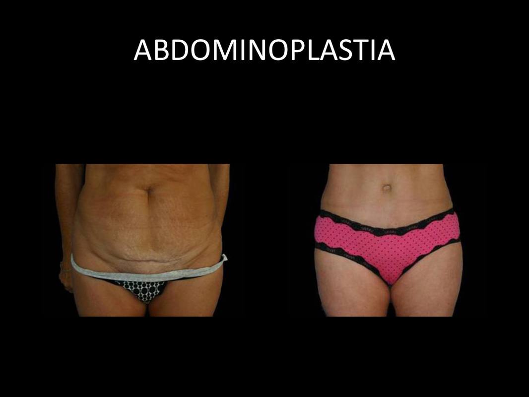 abdominoplastia_08