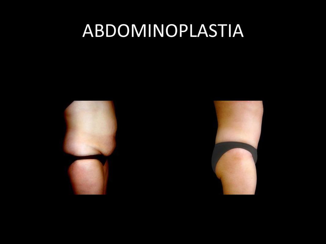 abdominoplastia_09