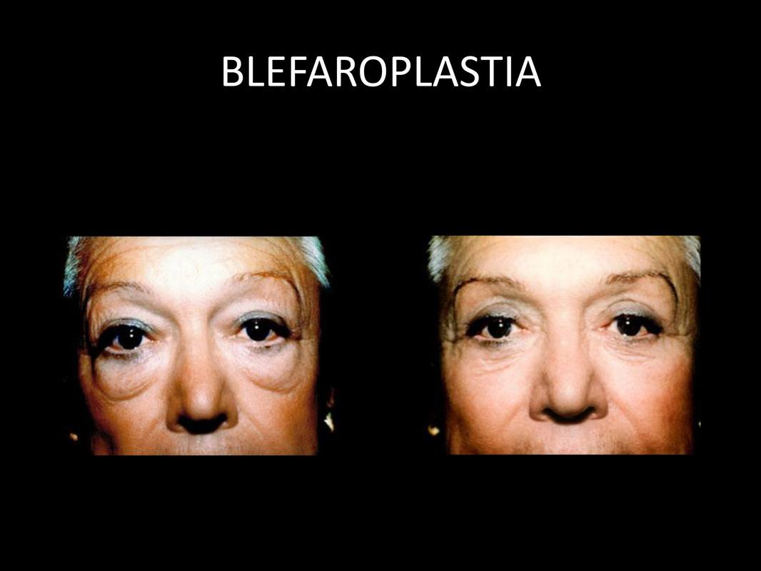 blefaroplastia_05