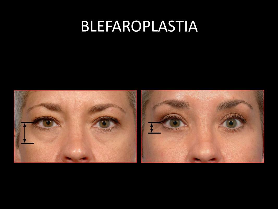 blefaroplastia_06