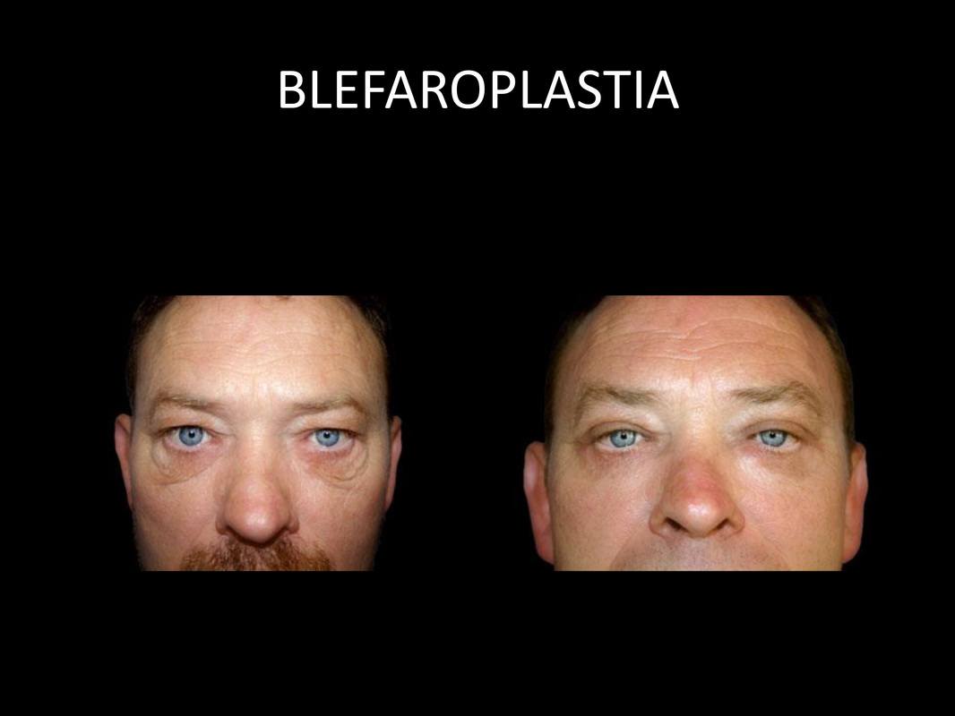 blefaroplastia_07