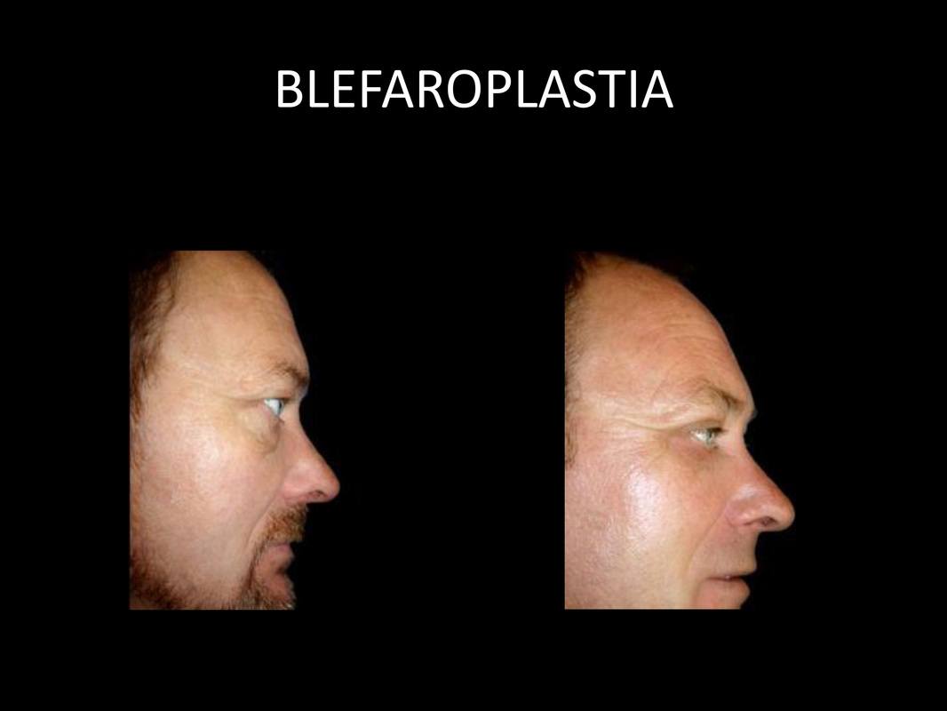 blefaroplastia_08