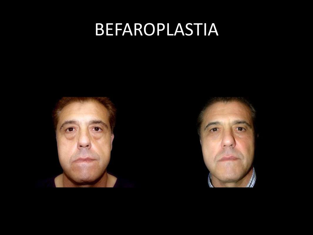 blefaroplastia_09