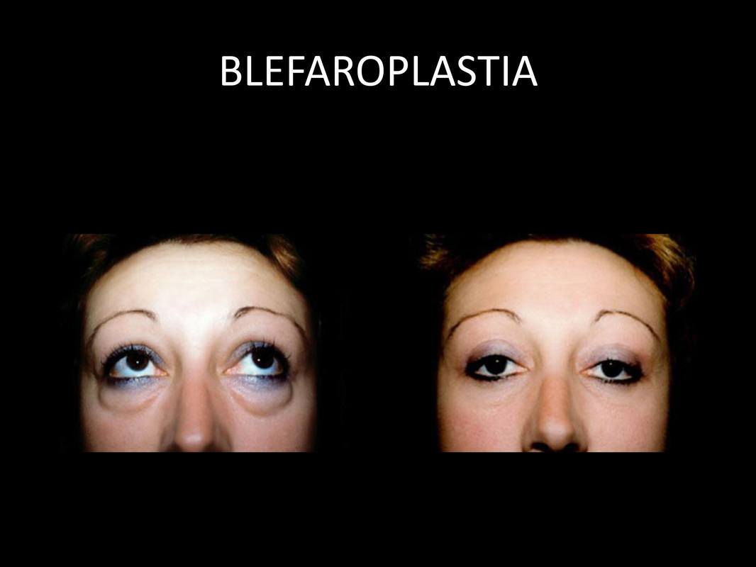 blefaroplastia_10