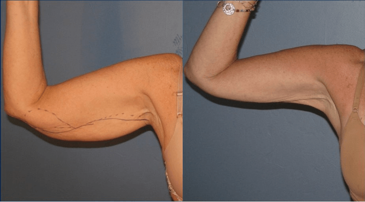 braquioplastia_02