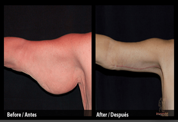braquioplastia_03