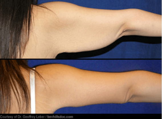 braquioplastia_04