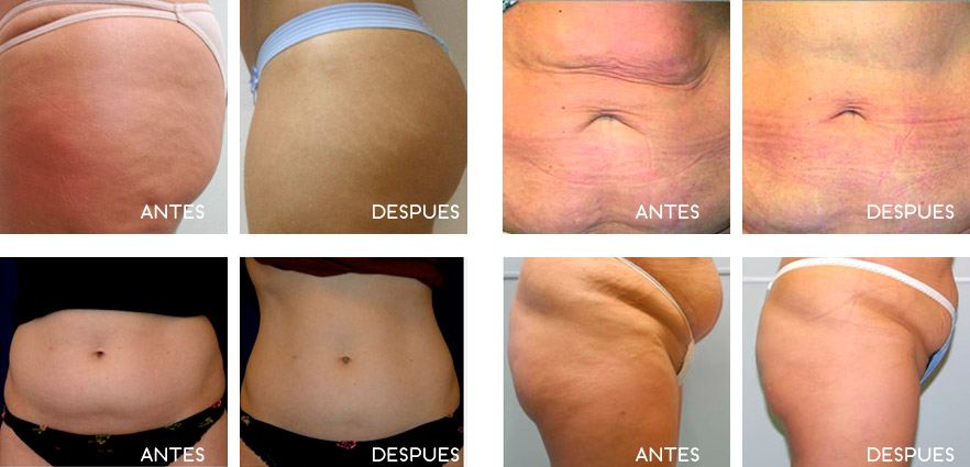 carboxiterapia_02