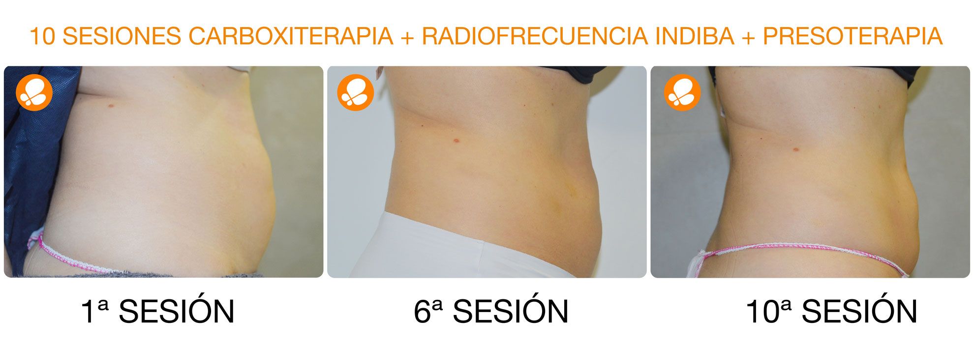 carboxiterapia_03