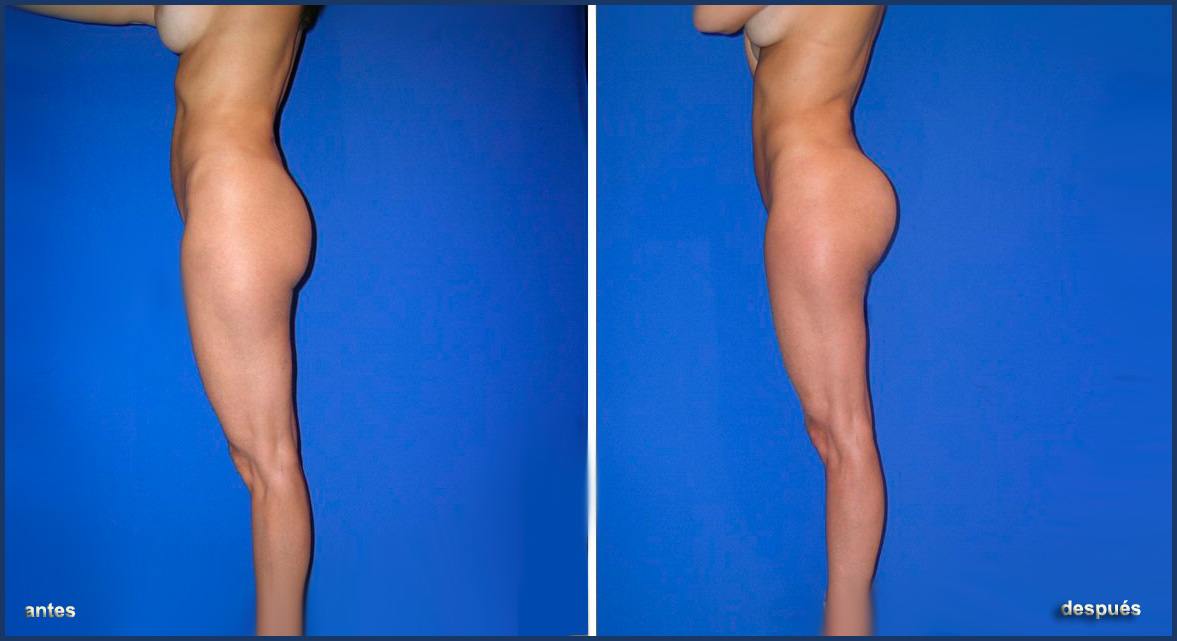 gluteos_02