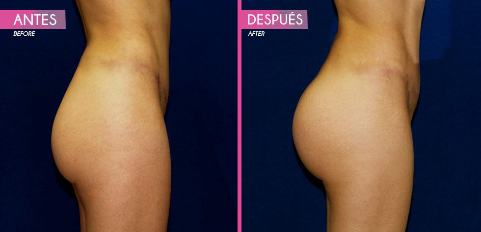 gluteos_03