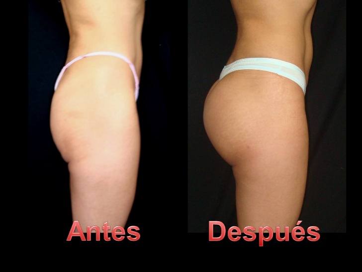 gluteos_04