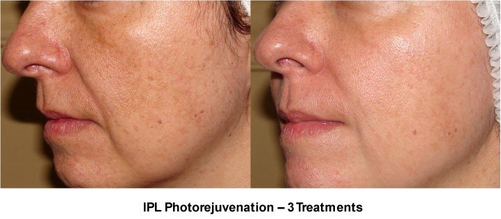 ipl_02