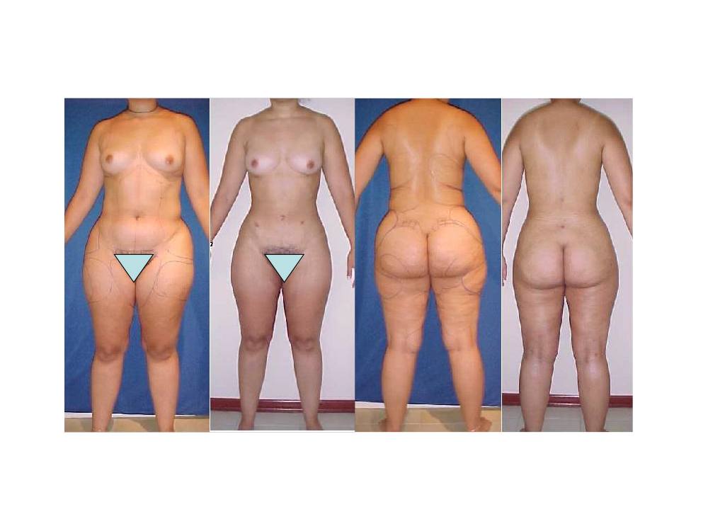 liposuccion_05