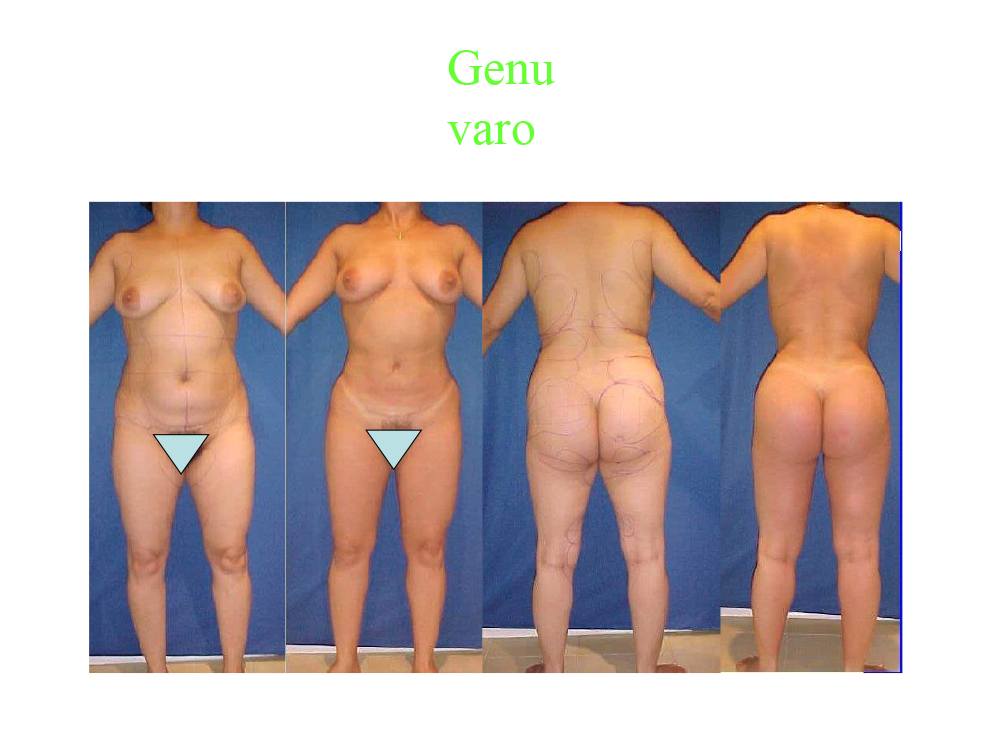 liposuccion_07