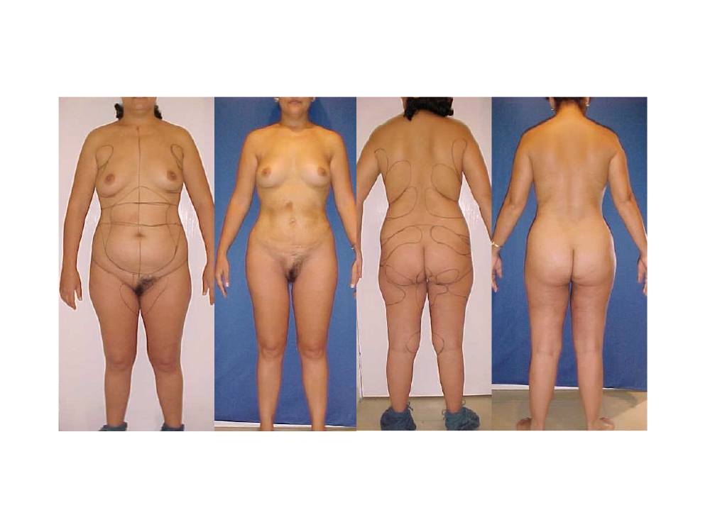 liposuccion_08
