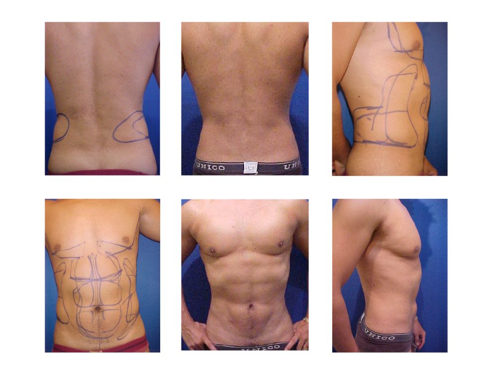liposuccion_09