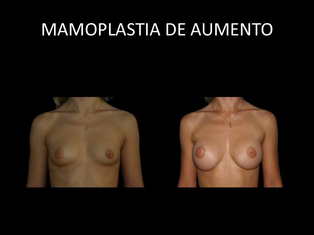 mamoplastia_de_aumento_03
