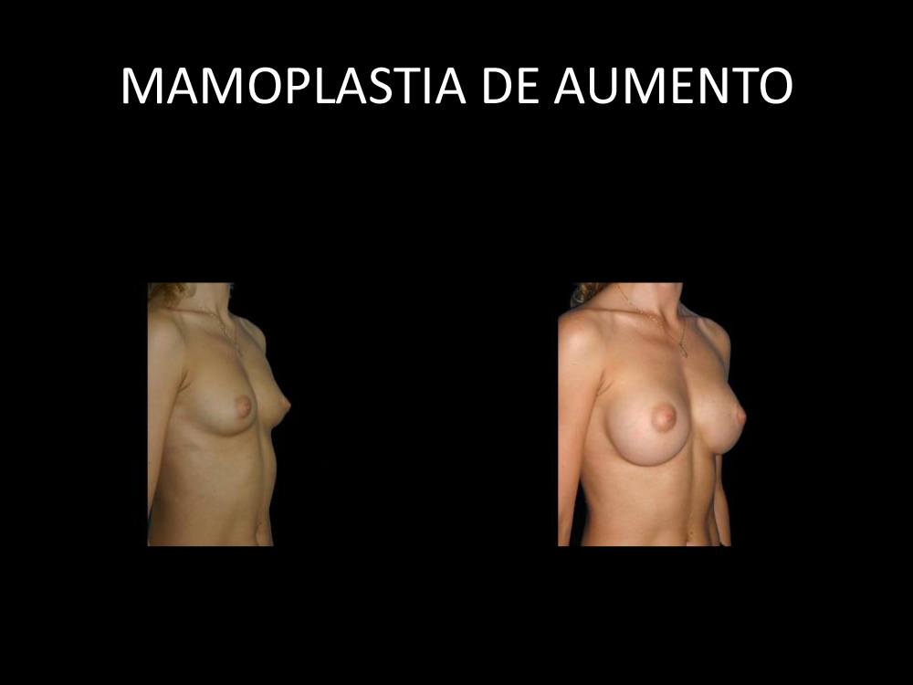 mamoplastia_de_aumento_04