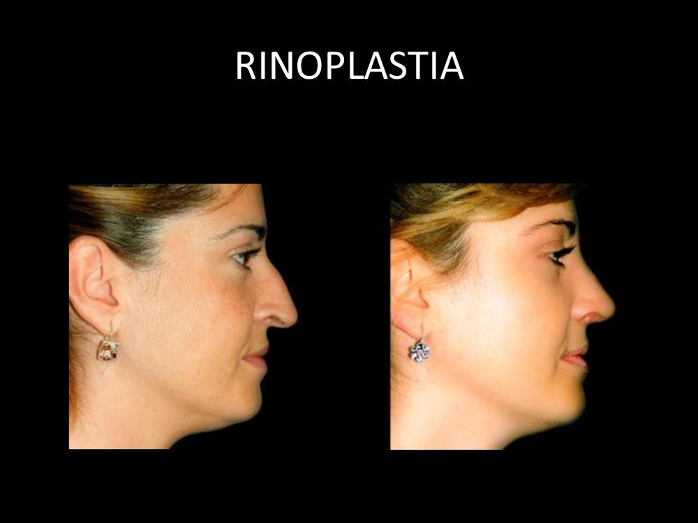rinoplastia_09