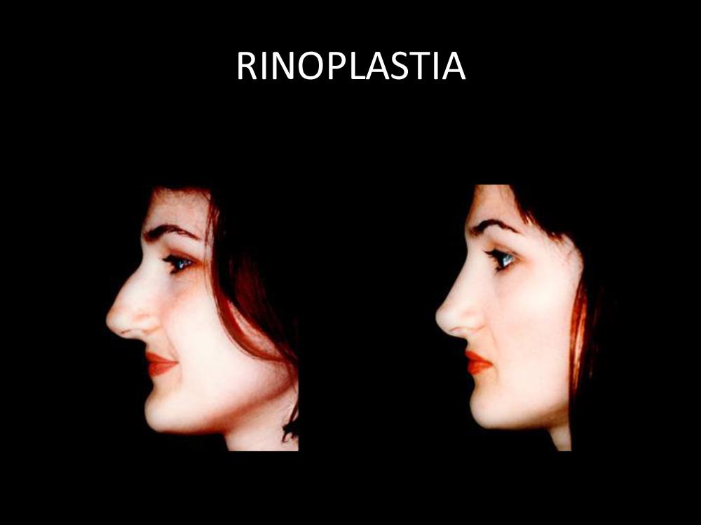 rinoplastia_10