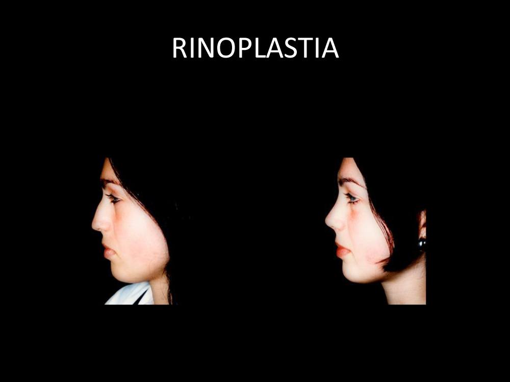 rinoplastia_11