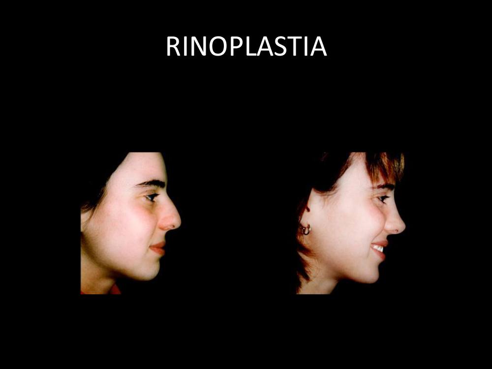 rinoplastia_12