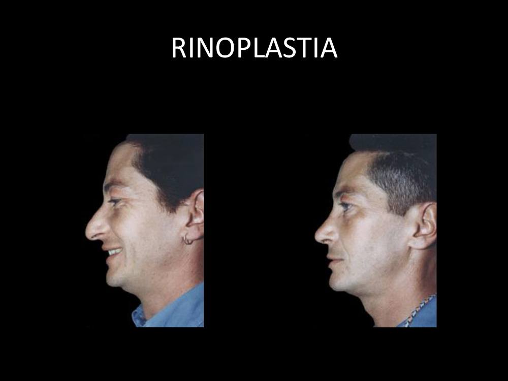 rinoplastia_13