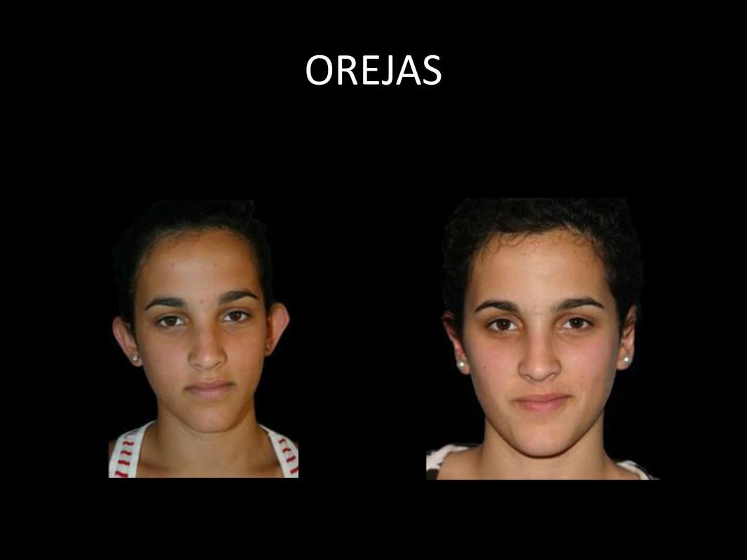 otoplastia_05