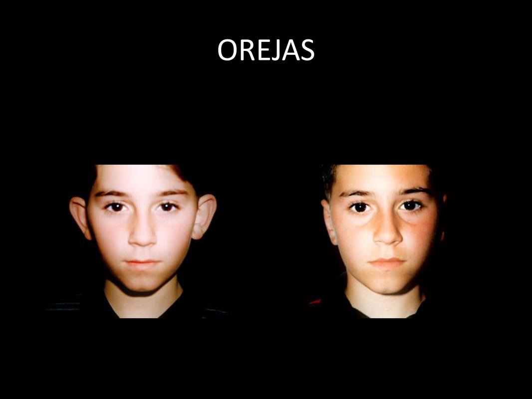 otoplastia_06