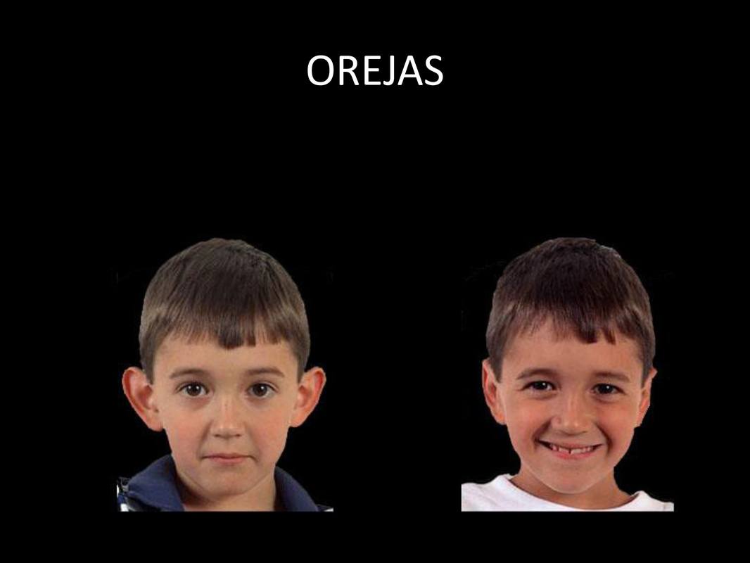 otoplastia_07